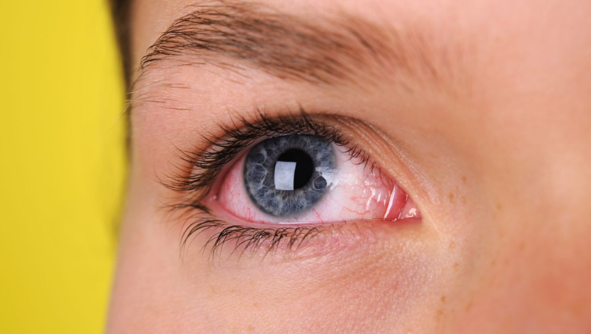 6 sai lầm trong điều trị đau mắt đỏ khiến bệnh lâu khỏi